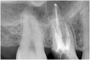 坂井2　根管充填
